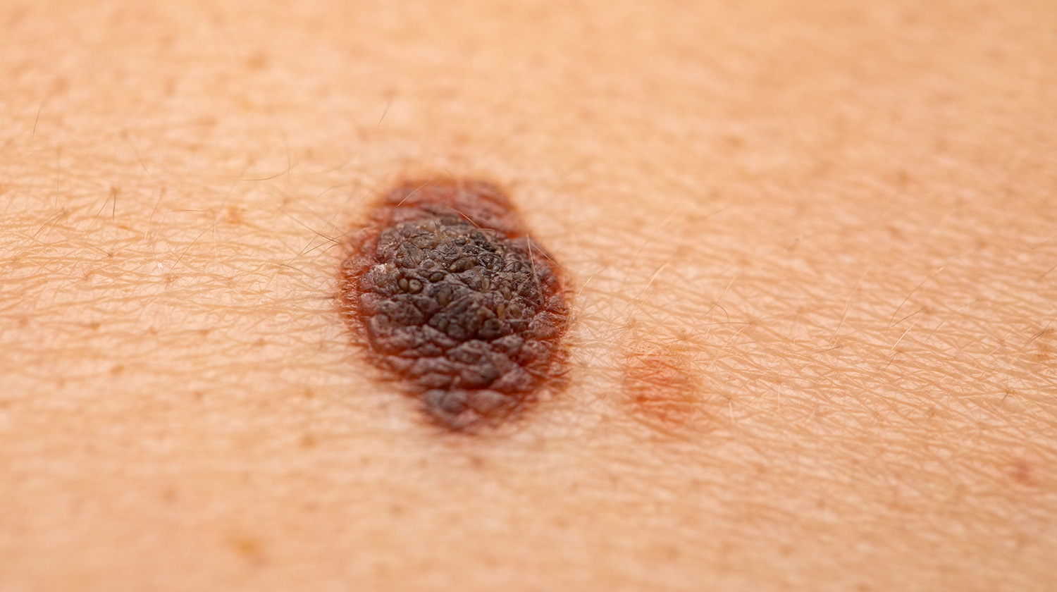 close-up of skin cancer mole